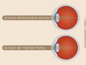 Υπερμετρωπία